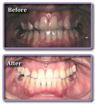 braces-set4-crp